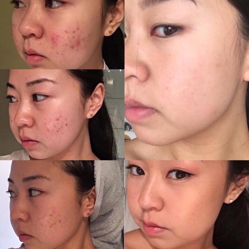 [Date2024]Kem ngừa mụn Differin gel Adapalene Gel 0.1% Acne Treatment