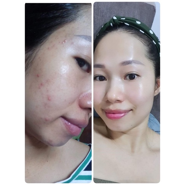 [Mua 2 tặng 1] Serum caramel essence 5ml ngừa mụn
