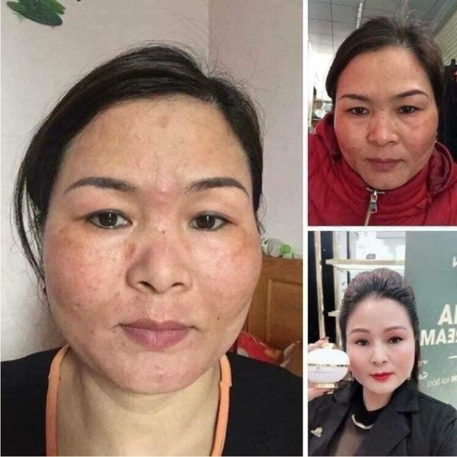 Cao nám hoàng cung Magic Skin Royal Melasma Plus