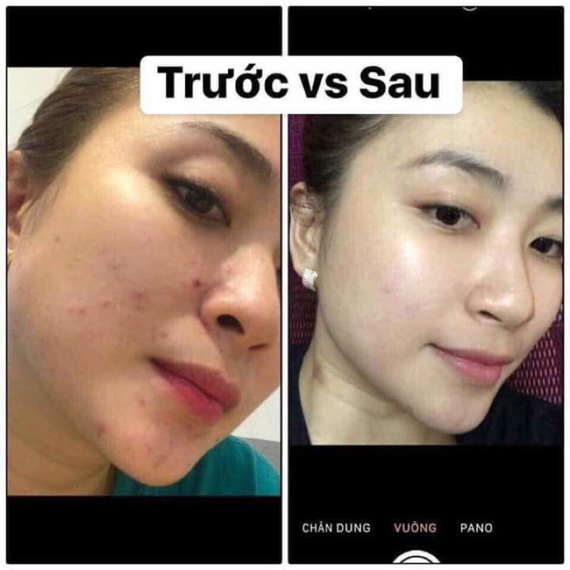 Tinh chất đông y , ko sưng , đỏ .Chuyên mụn , nám , tàn nhang , trắng da , đều màu da , se khít lỗ chân lông handmande