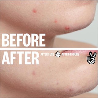Miếng dán mụn Peace Out Acne Healing Dots (gói 6 miếng)