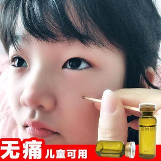Kem Tẩy Nốt Ruồi Không Đau Chất Lượng Cao