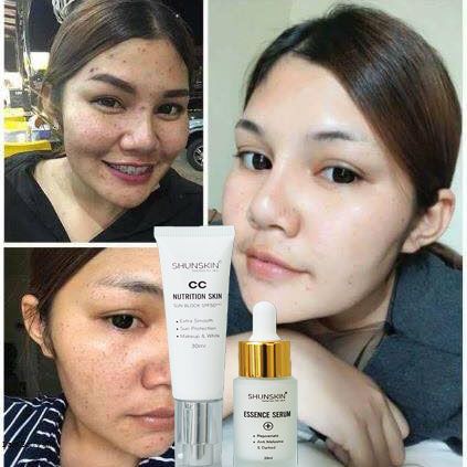 SHUN SKIN DIỆT TRỪ MỤN ĐẦU ĐEN XÓA TAN VẾT NÁM