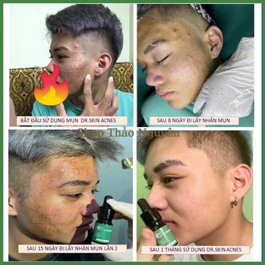 Serum mụn Dr.Skin acnes, sạch mụn Dr skinacnes 5ml bay mụn hết thâm làm mịn da hiệu quả trong 7 ngày