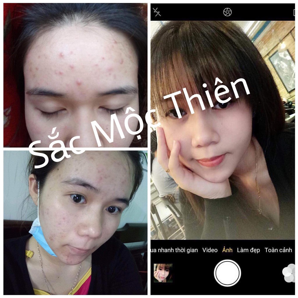 tái tạo da sắc mộc thiên - CHÍNH HÃNG MIỀN BẮC - Hỗ trợ giảm thâm mụn, nám, sẹo rỗ sau 1 liệu trình sử dụng | BigBuy360 - bigbuy360.vn