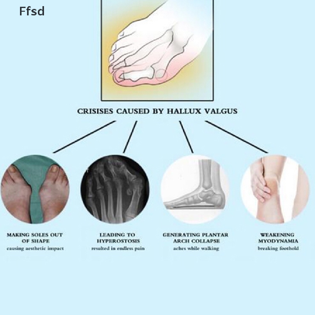 1 Nẹp Nẹp Chỉnh Hình Ngón Chân Cái Giảm Đau Điều Chỉnh Được