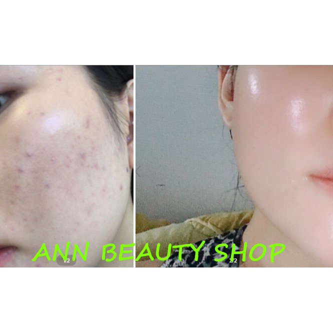 Tinh chất The Ordinary Niacinamide 10% + Zinic 1% | BigBuy360 - bigbuy360.vn