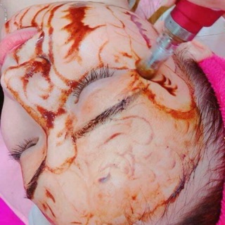 HCM [VOUCHER] CẤY HỒNG SÂM TẠI Skin House