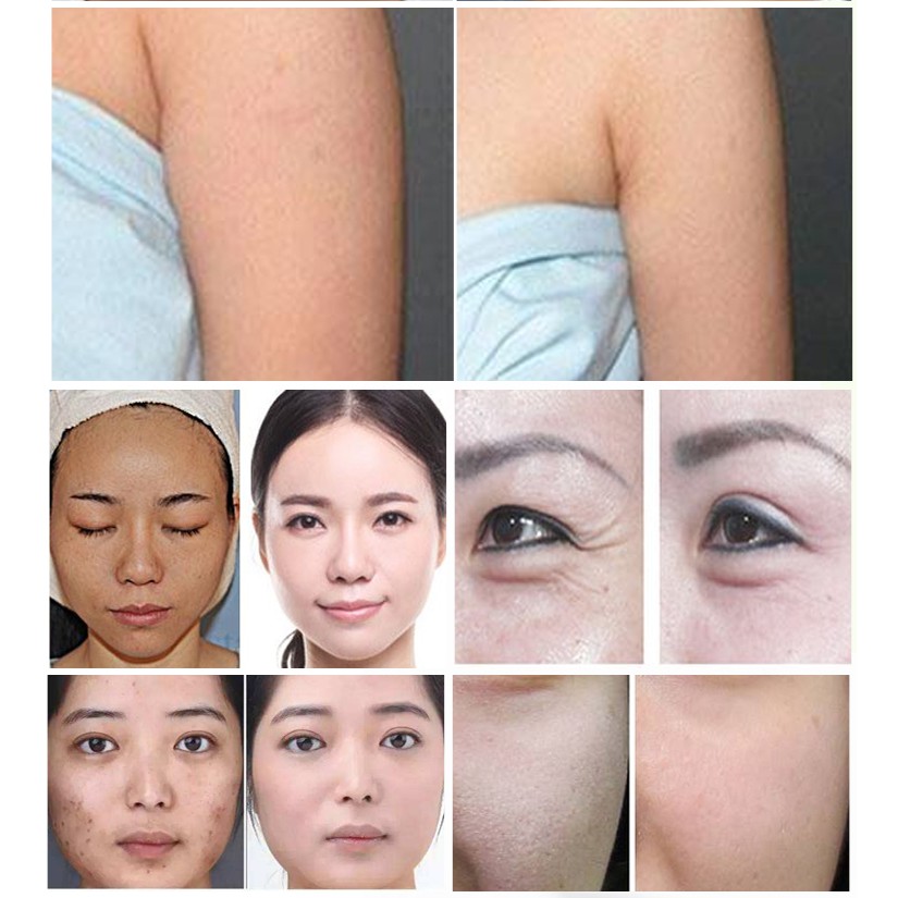 Máy nâng cơ trẻ hóa da xóa nhăn tạo mặt Vline HIFU Vmax