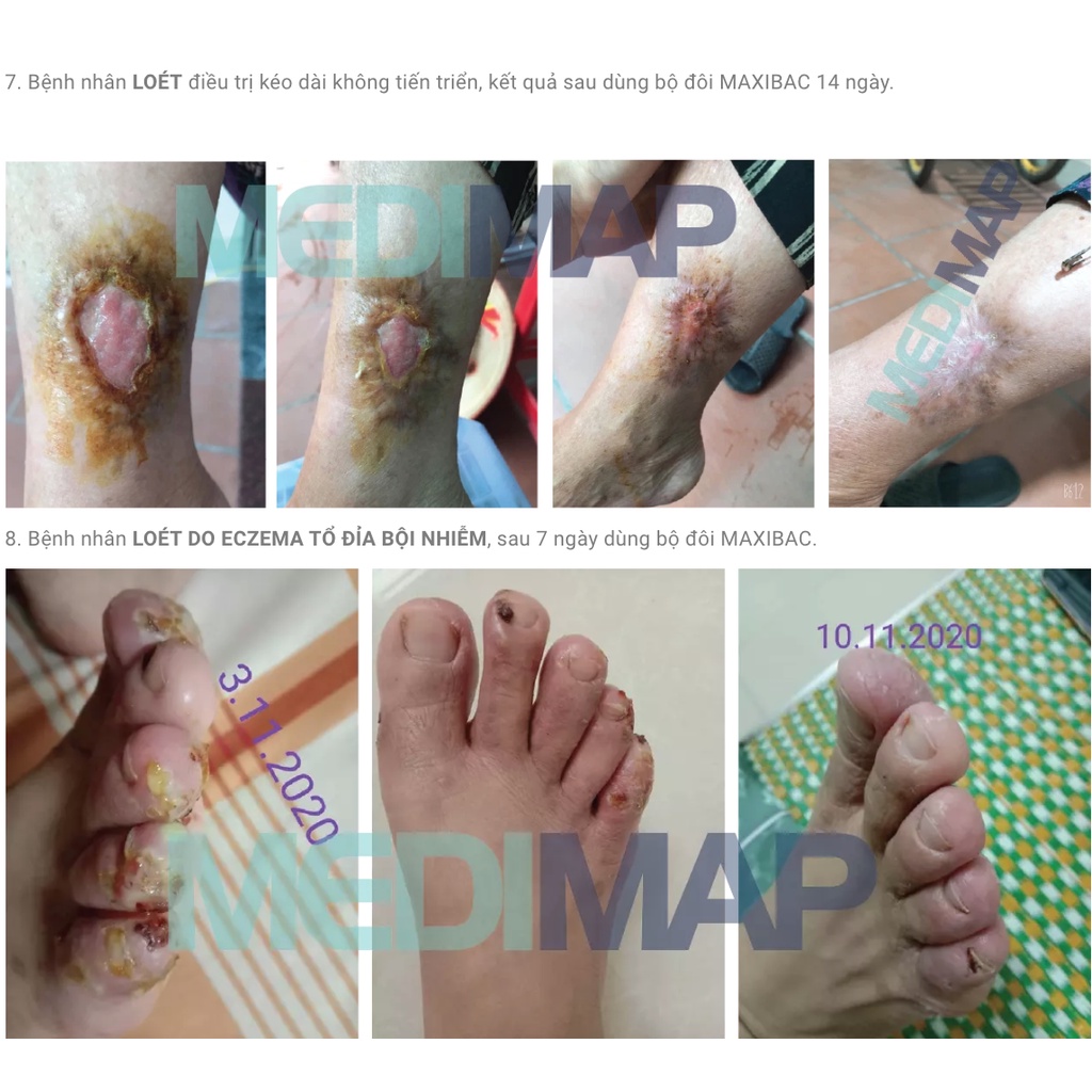 Xịt Kháng Khuẩn Nhanh Lành Vượt Trội Maxibac Spray Không Xót, Vệ Sinh Khu Trú, Ngăn Chặn Lây Lan, An Toàn Cho Trẻ Em
