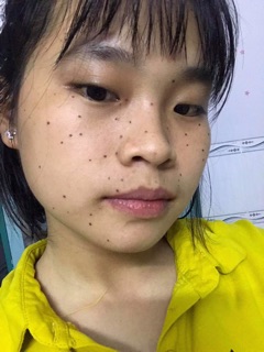 CHẤM CHÂN TÀN NHANG,NỐT RUỒI,MỤN THỊT
