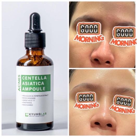 Serum Giảm Mụn Kyung Lab Acnes Centella Asiatica Ampoule 50ml Kiềm Dầu Mờ Thâm