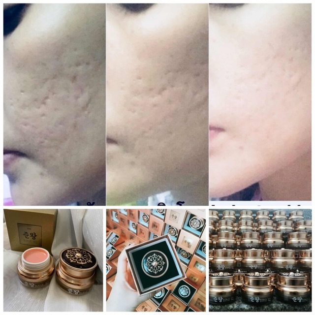 [tặng soap] Thuốc đông y trị sẹo rỗ Genie Non Fix Skin MTS Hoàng Cung Hàn Quốc Chính Hãng