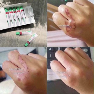 Kem trị sẹo Gentacin Nhật Bản