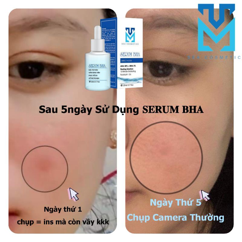 SERUM SEA T R Ị T H Â M   tặng 30ml sữa rửa mặt riibe