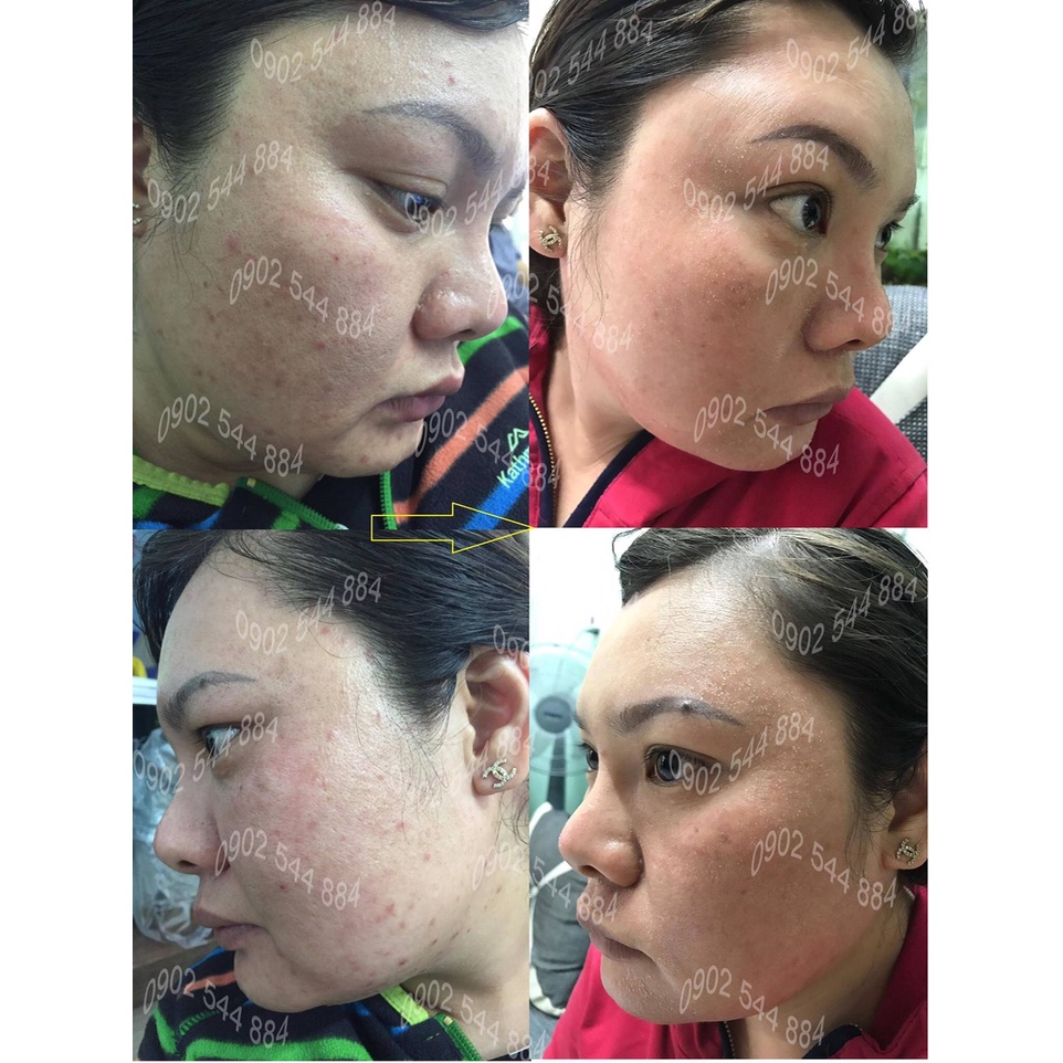 Serum nám Hoàng Trinh