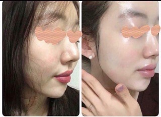 RED PEEL THAY DA SINH HỌC 20ML