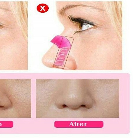 Kẹp Nâng Mũi Nose Up Siêu Nhỏ Gọn