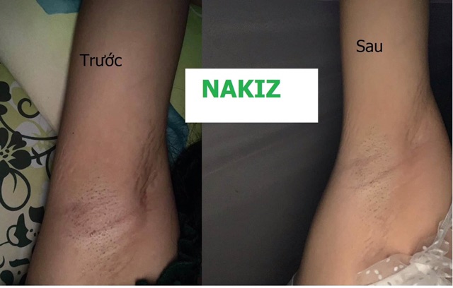 3 TUÝP NAKIZ LIVELY BUTT 〡 Kem thoa thâm Mông, Bẹn, Nách, Lưng, Nhũ hoa, Đầu gối, Cùi chỏ.... Thái Lan | BigBuy360 - bigbuy360.vn