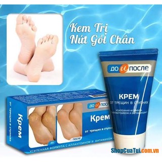 KEM TRỊ NỨT GÓT CHÂN KPEM NGA