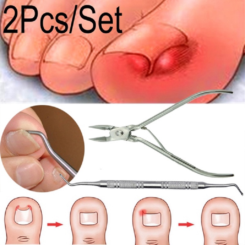 Set 2 dụng cụ lấy khóe chân tiện lợi