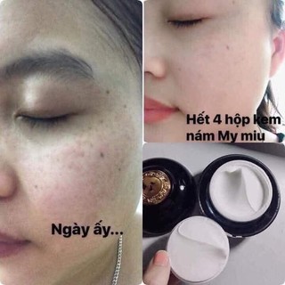 Kem Mờ Nám, Tàn Nhang MyMiu