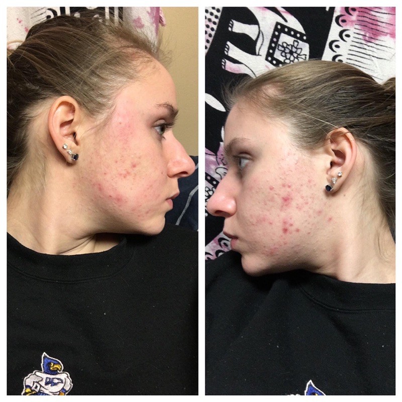 Treatment chữa mụn benzoyl acne org acne.org - Hàng chính hãng