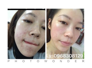 Toner giấm táo