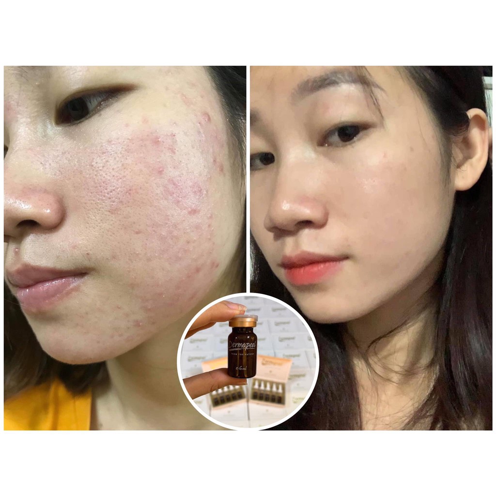 Tảo trứng cá tuyết Dermapeel+ KHÔNG BONG DA - Vì Làn Da Hoàn Hảo - SẠCH MỤN - MỜ THÂM NÁM - TÁI TẠO MÔ DA