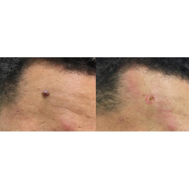 Kem tẩy nốt ruồi, sẹo lồi, mụn cóc hiệu quả | BigBuy360 - bigbuy360.vn