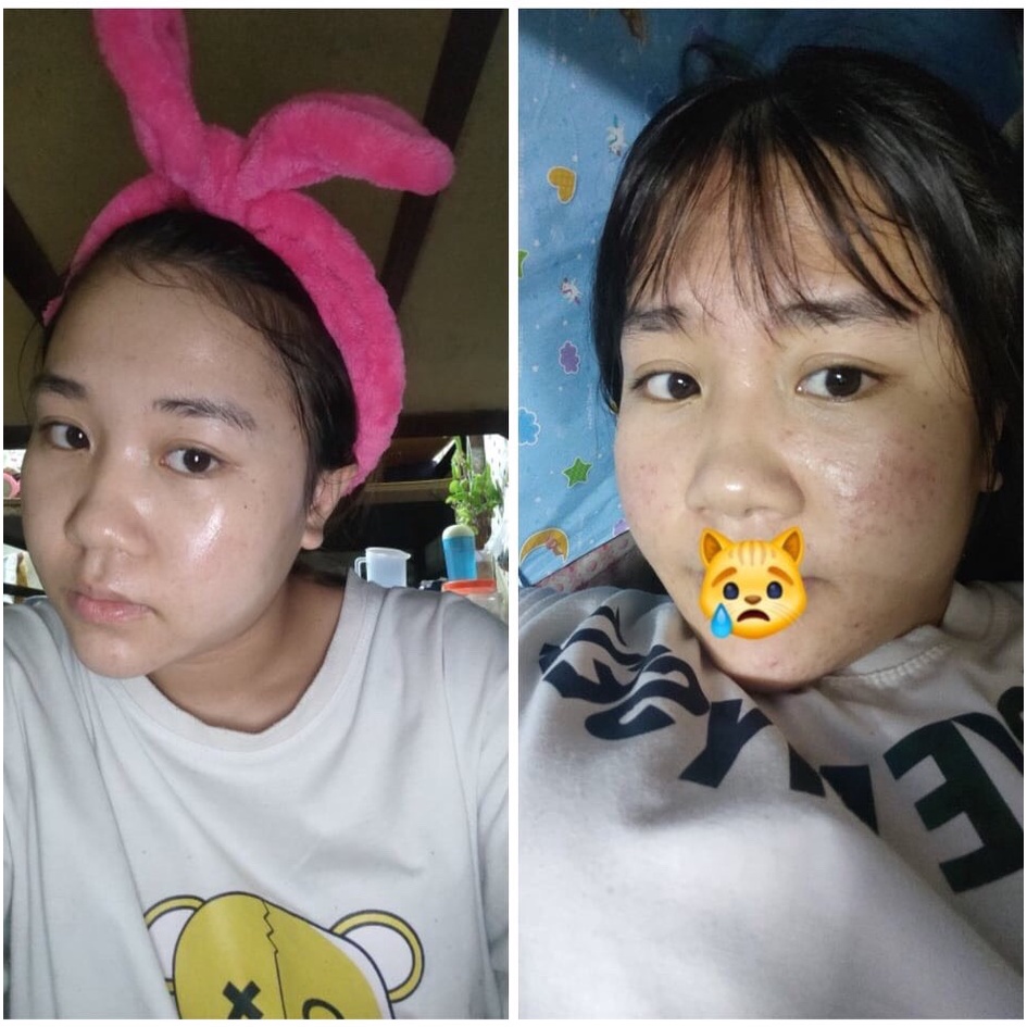 Serum giảm mụn mờ thâm, Dr skinbeauty, Ngừa mụn, Mờ thâm 5ml