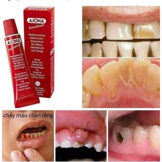 Kem đánh răng y tế cô đặc Ajona 25ml (Đức)