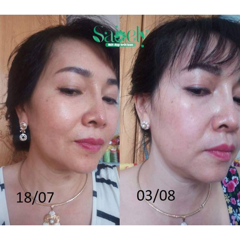 Kem nám Dermisa Brightening 42g từ Mỹ - Loại bỏ Nám, tàn nhang và dưỡng trắng hồng da