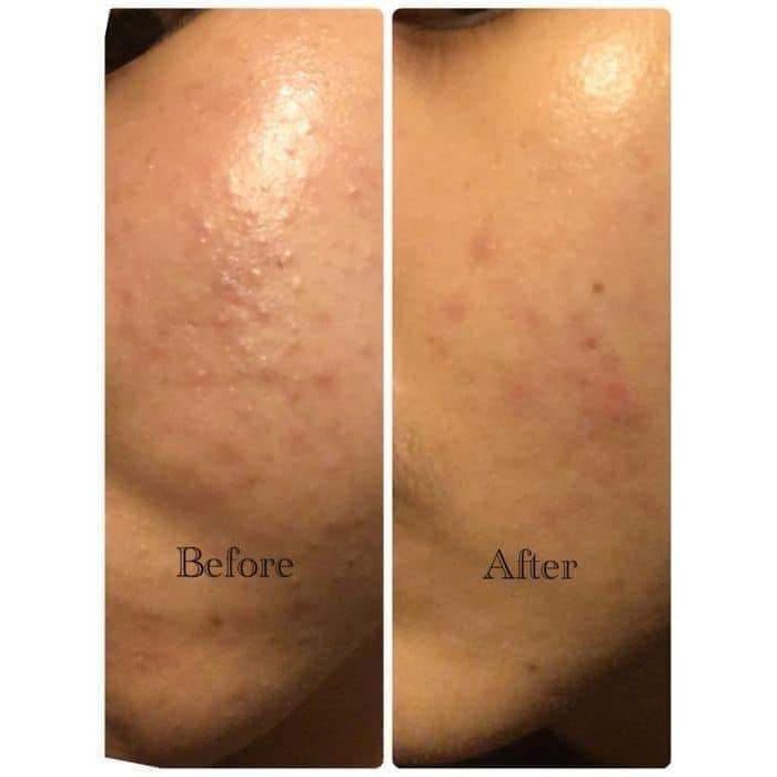 Serum dưỡng trắng da, mờ thâm, hỗ trợ giảm mụn for beloved one mandelic acid các loại 15ml