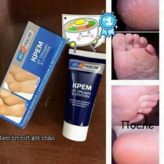 Kem trị nứt gót chân Kpem