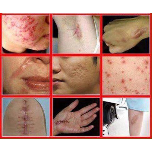 CAM KẾT CHÍNH HÃNG_Kem Sẹo Scar Esthetique 10g từ Mỹ | BigBuy360 - bigbuy360.vn