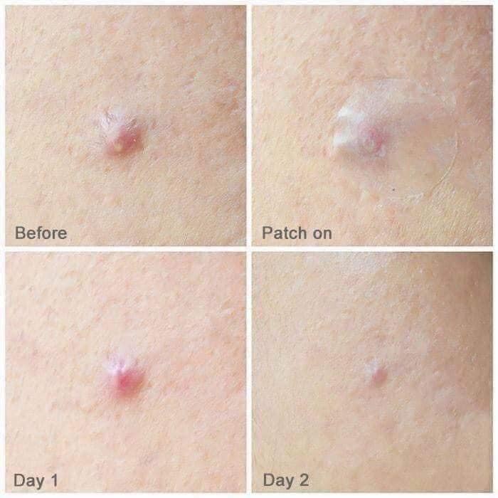 Miếng dán mụn Corsx Acnes Pimple Master Patch