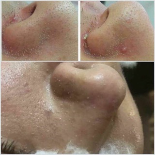 Ủ MỤN ĐẦU ĐEN YOUNGERC