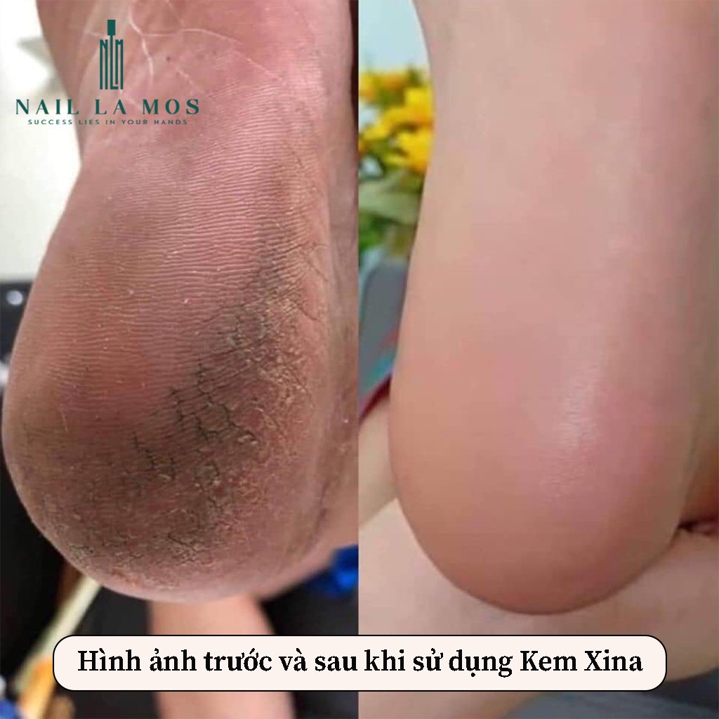 Kem mềm da nail Xina - Kem làm mềm da cải thiện tình trạng thô ráp, sần sùi