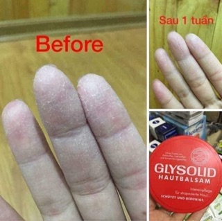 Kem trị nứt gót chân, á sừng, vảy nến Glysolid