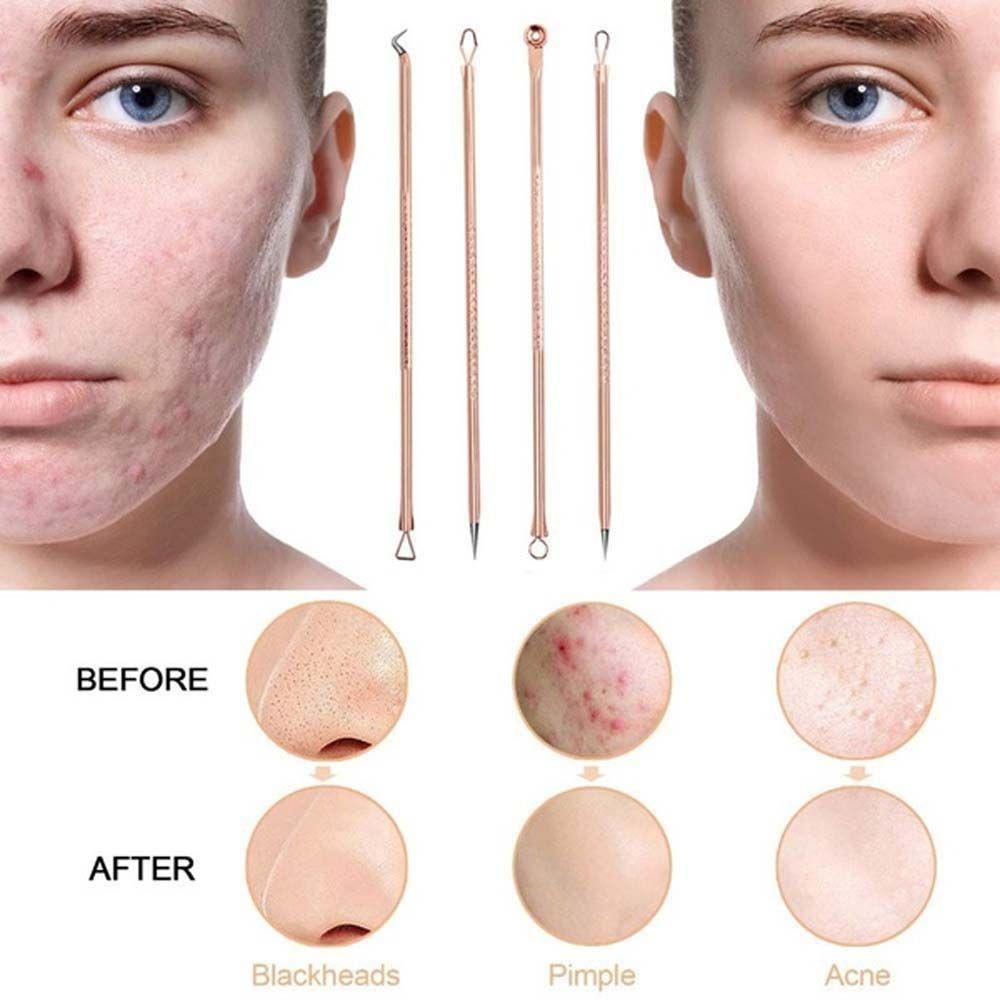 QQMALL Dụng Cụ Nặn Mụn Đầu Đen Bằng Thép Không Gỉ