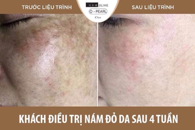 SERUM JIUHE PHIÊN BẢN MỚI 2020