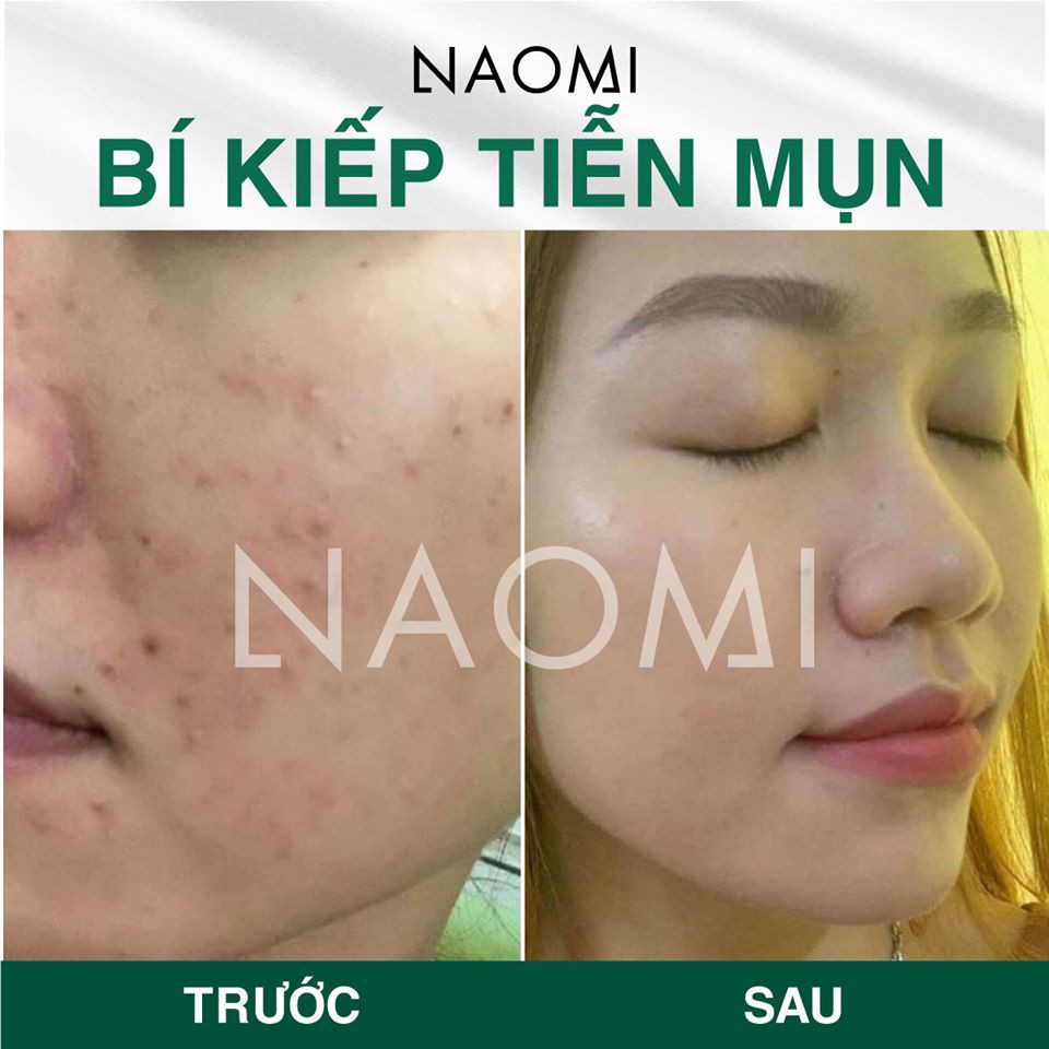 COMBO Trị mụn thâm Naomi | BigBuy360 - bigbuy360.vn