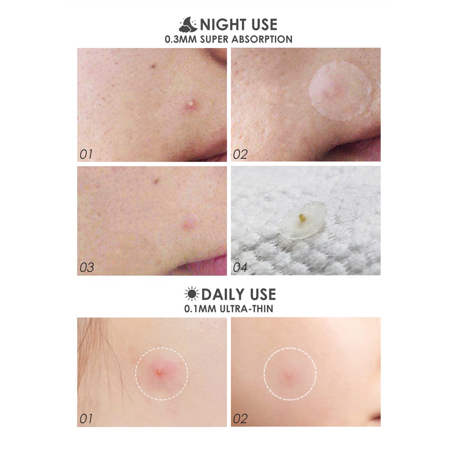Miếng dán mụn FOCALLURE trong suốt sử dụng ban ngày/ ban đêm
