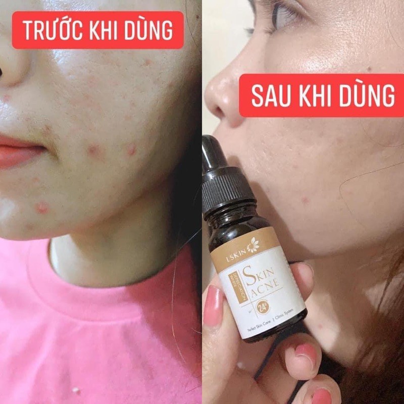 Cốt mụn Bạch Sen Skin care acne Lskin Đan Thy | BigBuy360 - bigbuy360.vn