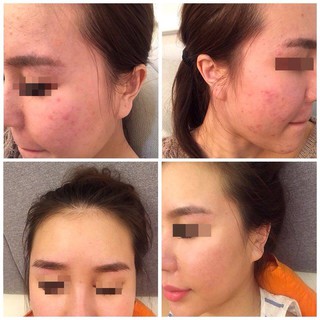 Tinh chất Dermafirm - Kiểm soát Dầu Mụn - Purifying Essence