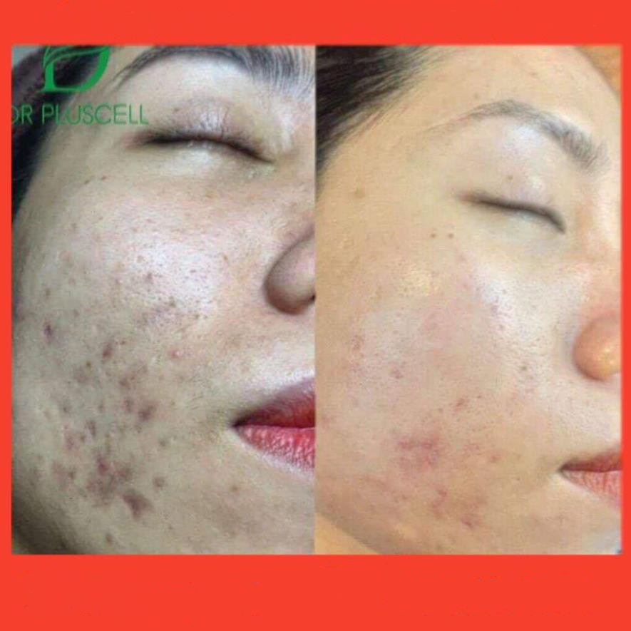 Tế bào gốc, tinh chất tế bào gốc 6GF Exosome Ampoule Dr Pluscell