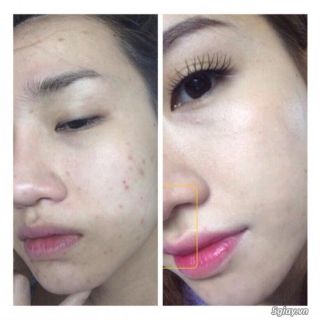 Mặt nạ ngũ hoa hạt