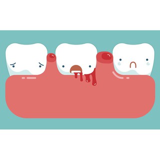 Kem đánh răng Emoform trị viêm lợi