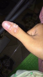 Mụn cơm, mụn cóc, mắt cá